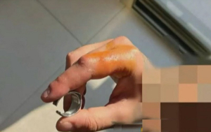 Χαλκιδική: Πήγε σε Νοσοκομείο να του βγάλουν δαχτυλίδι – Φώναξαν… ηλεκτρολόγο να βοηθήσει!