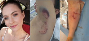 «Έμεινα άνεργη» λέει η 34χρονη μητέρα που δέχτηκε επίθεση από σκυλιά - Δεν έχουν κλείσει οι πληγές της